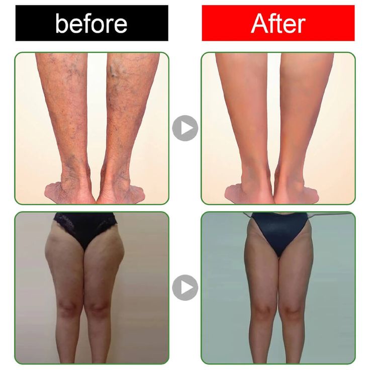 Patchs detox Kinoki